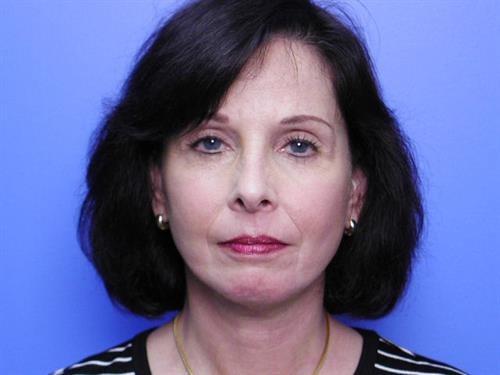 Facelift after at Adrian Yi, MD in Los Angeles, CA