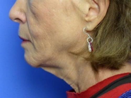Chin Implant before at Adrian Yi, MD in Los Angeles, CA