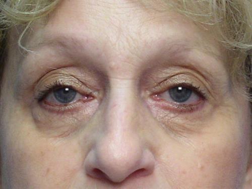 Laser Skin Resurfacing before at Adrian Yi, MD in Los Angeles, CA