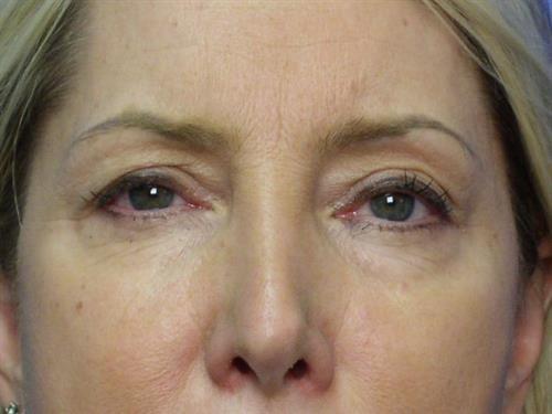 Laser Skin Resurfacing before at Adrian Yi, MD in Los Angeles, CA