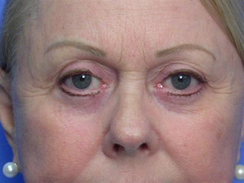 Adrian Yi, MD laser treatment after — Los Angeles, CA