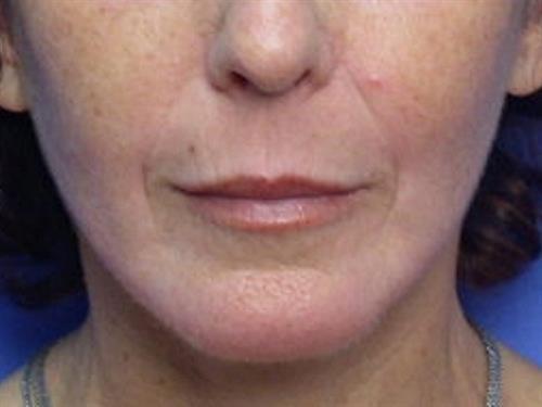 Laser Skin Resurfacing after at Adrian Yi, MD in Los Angeles, CA