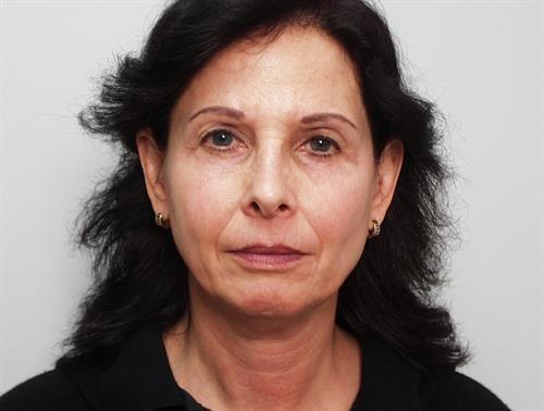 Facelift before at Adrian Yi, MD in Los Angeles, CA
