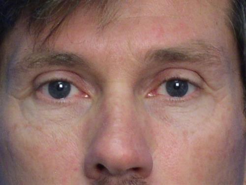 Adrian Yi, MD laser treatment after — Los Angeles, CA