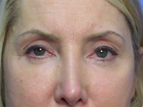 Laser Skin Resurfacing after at Adrian Yi, MD in Los Angeles, CA