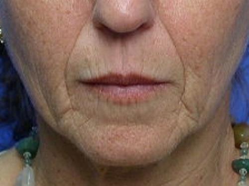 Laser Skin Resurfacing before at Adrian Yi, MD in Los Angeles, CA