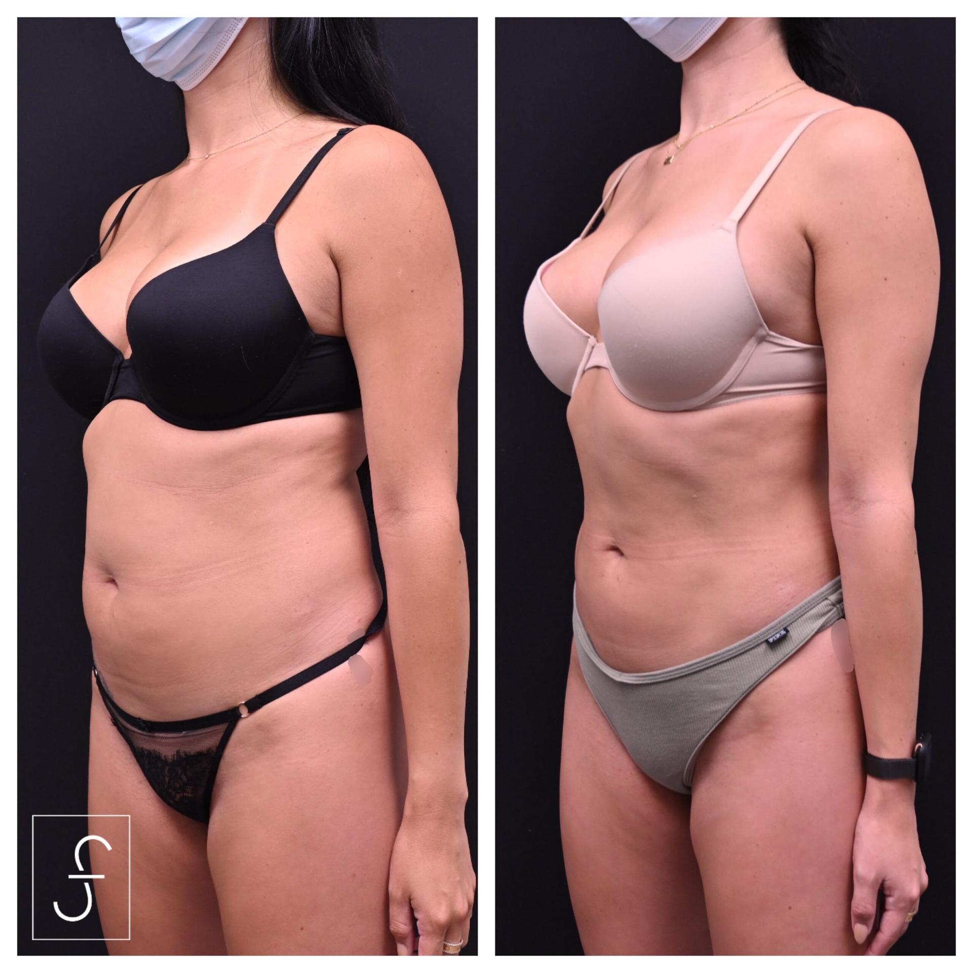 Shahin Fazilat, MD liposuction result — Mountain View, CA
