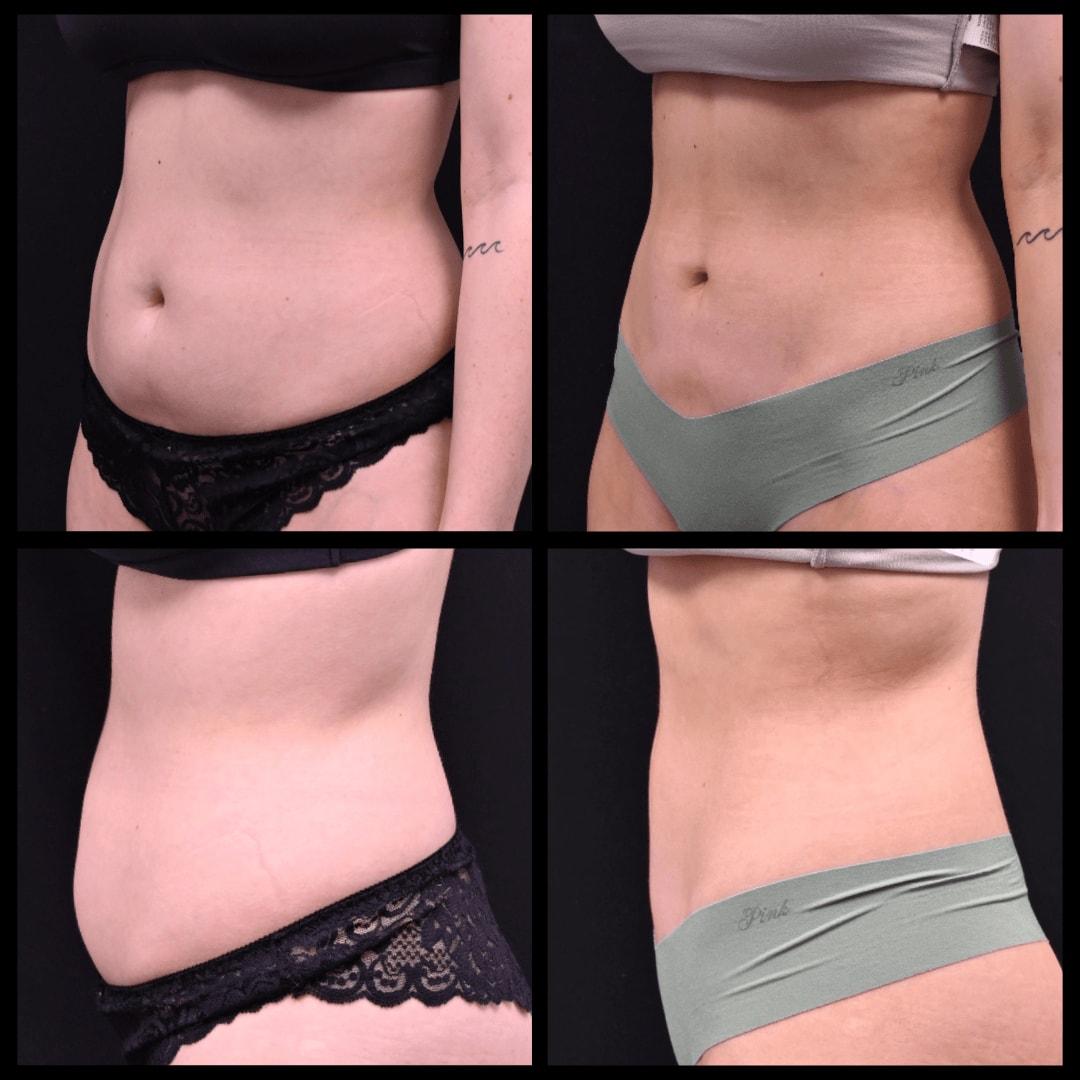 Shahin Fazilat, MD liposuction result — Mountain View, CA