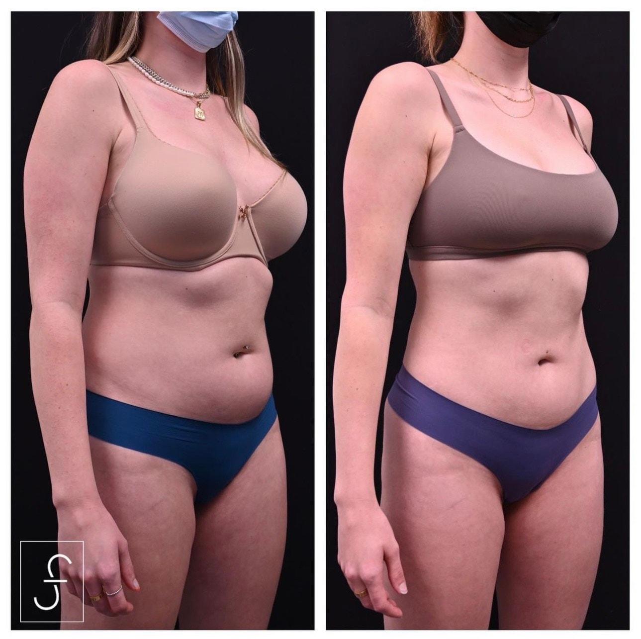 Shahin Fazilat, MD liposuction result — Mountain View, CA