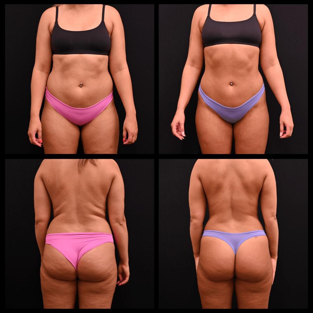 Shahin Fazilat, MD liposuction result — Mountain View, CA