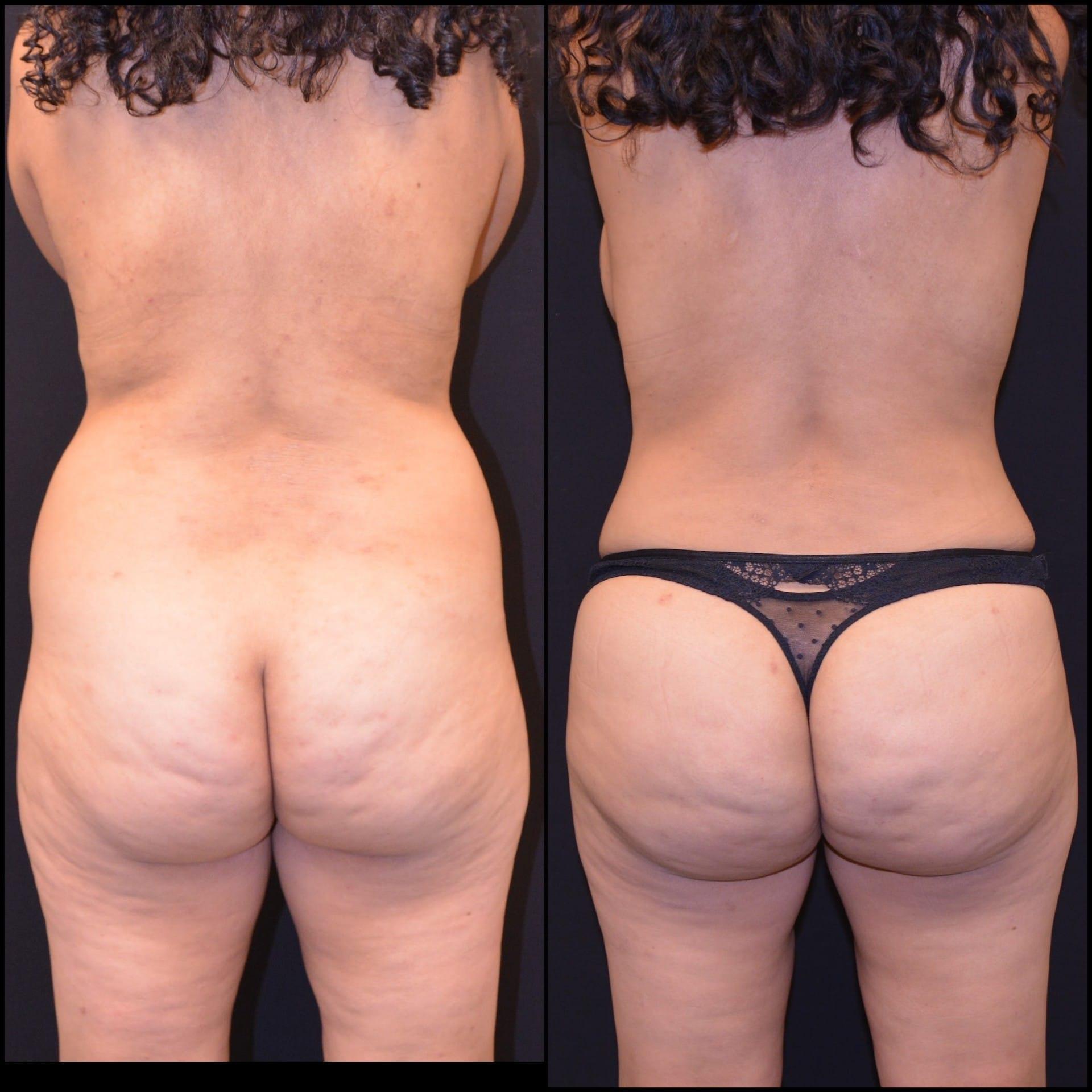 Shahin Fazilat, MD liposuction result — Mountain View, CA
