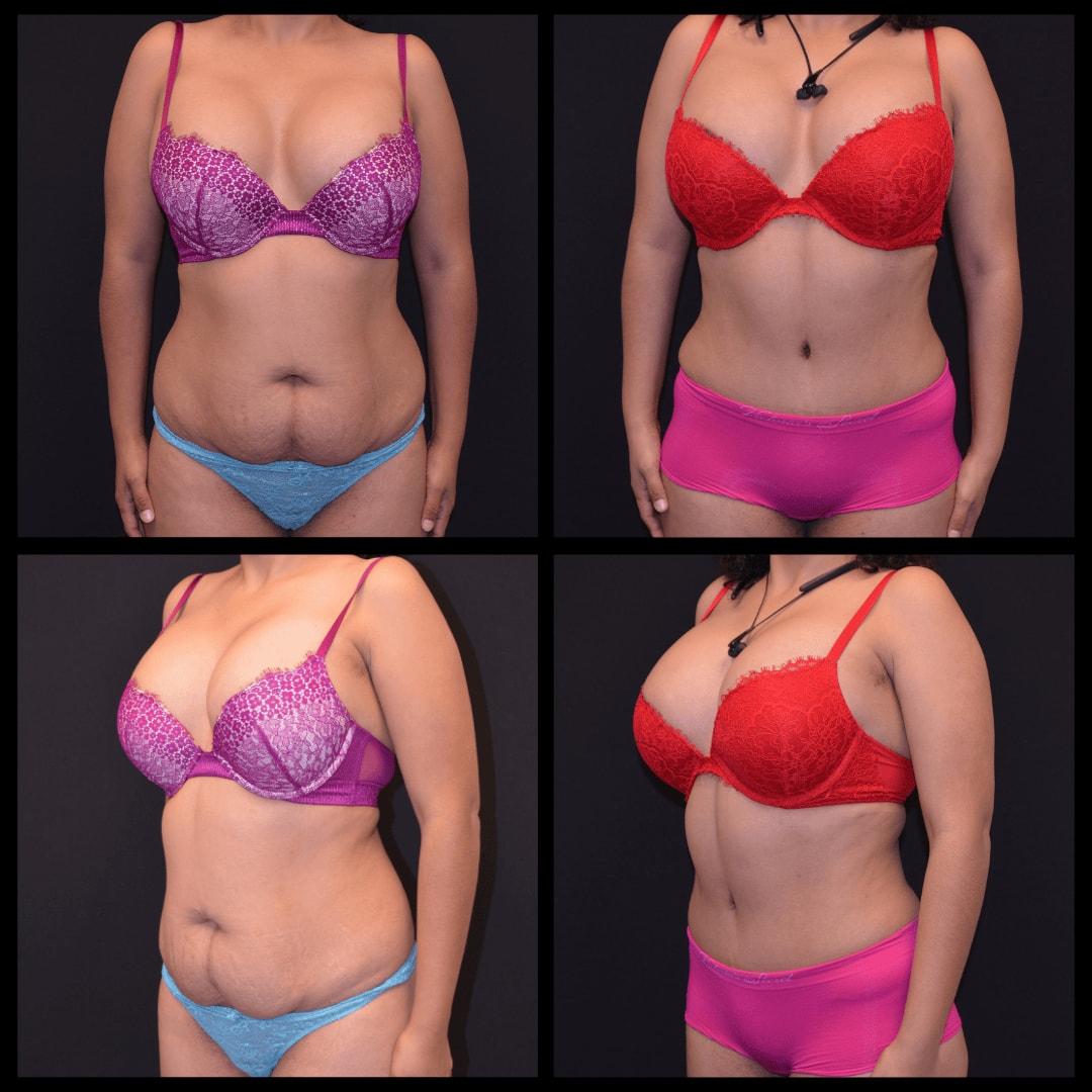 Shahin Fazilat, MD tummy tuck result — Mountain View, CA