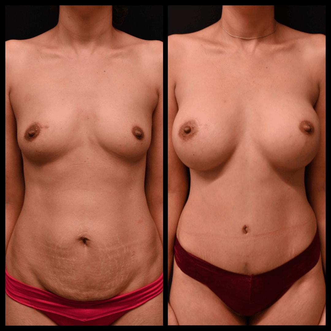 Shahin Fazilat, MD mommy makeover result — Mountain View, CA
