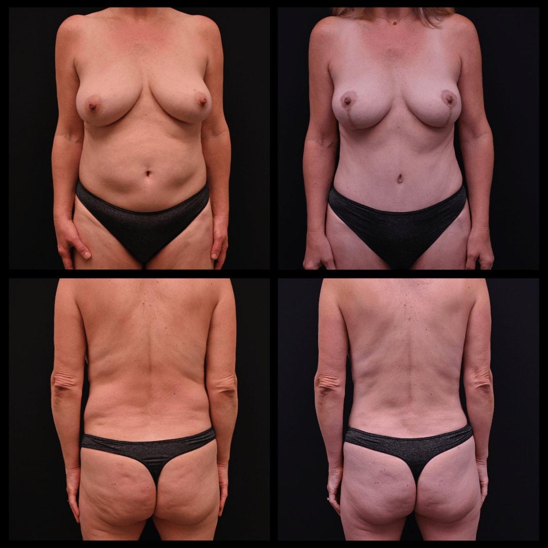 Shahin Fazilat, MD mommy makeover result — Mountain View, CA