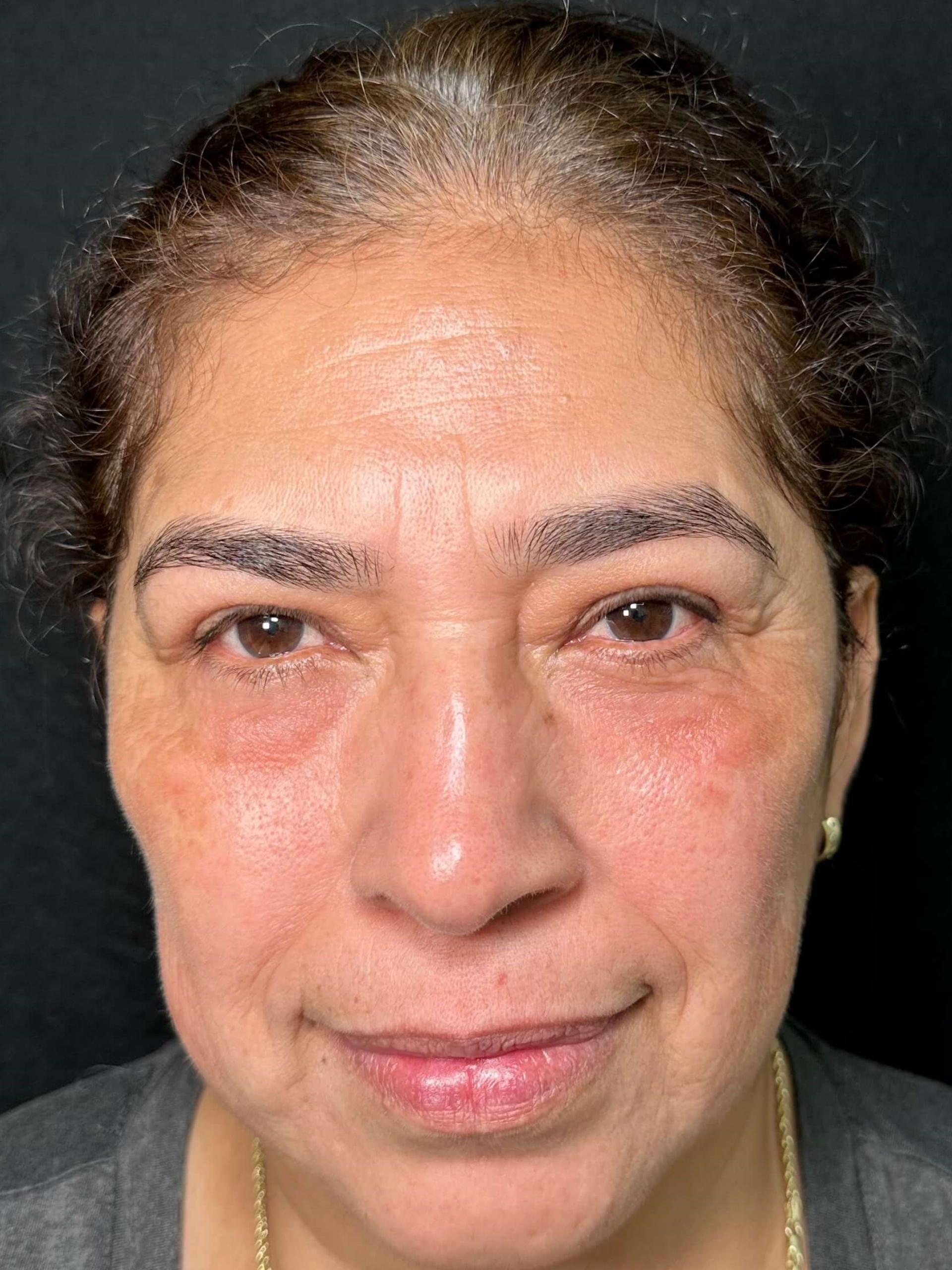 The Plastics Doc (Samuel Salcedo, MD) eyelid lift after — Corona, CA