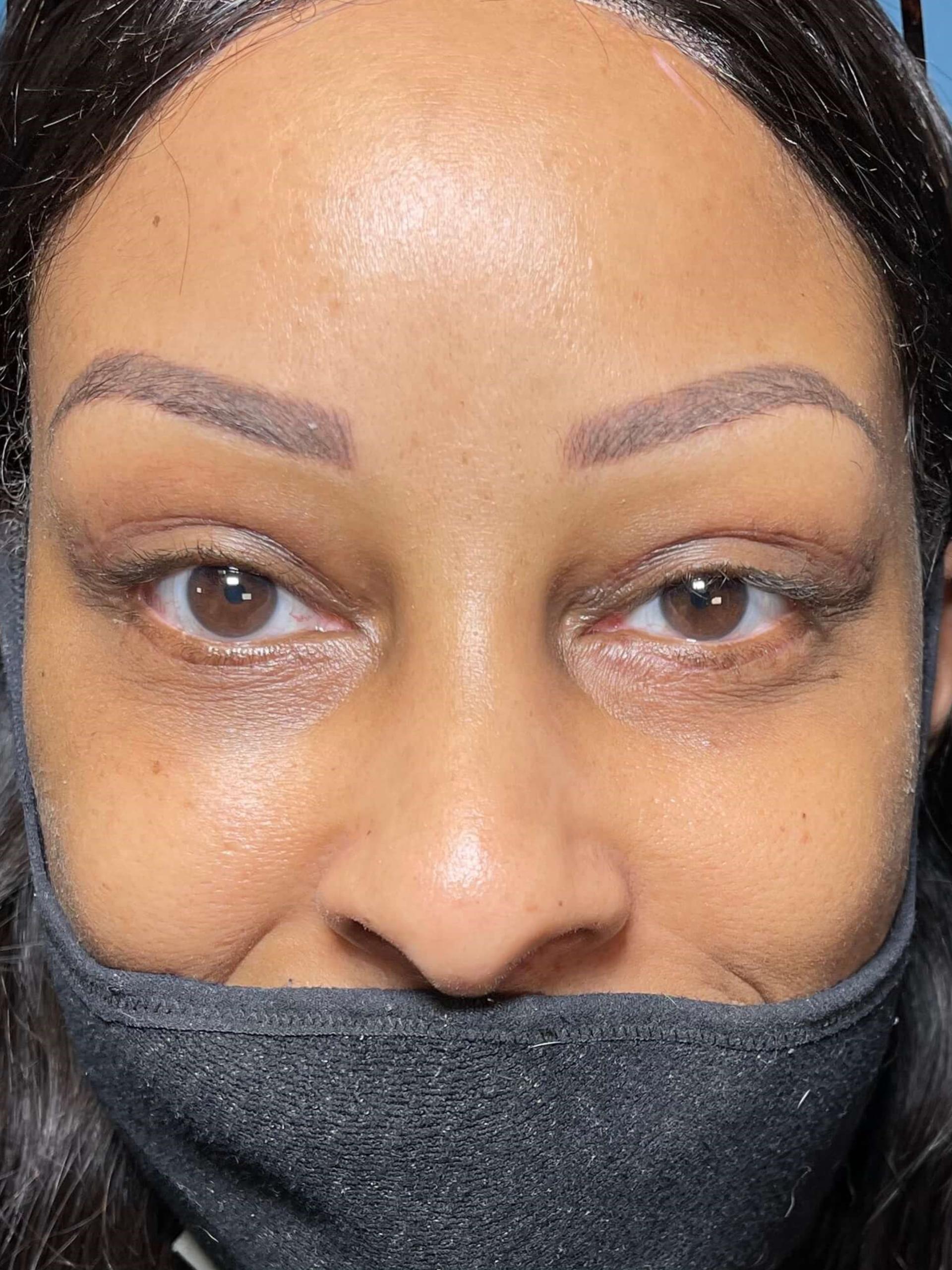 The Plastics Doc (Samuel Salcedo, MD) eyelid lift after — Corona, CA