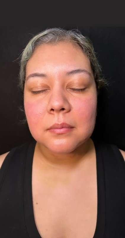 The Plastics Doc (Samuel Salcedo, MD) neck liposuction after — Corona, CA