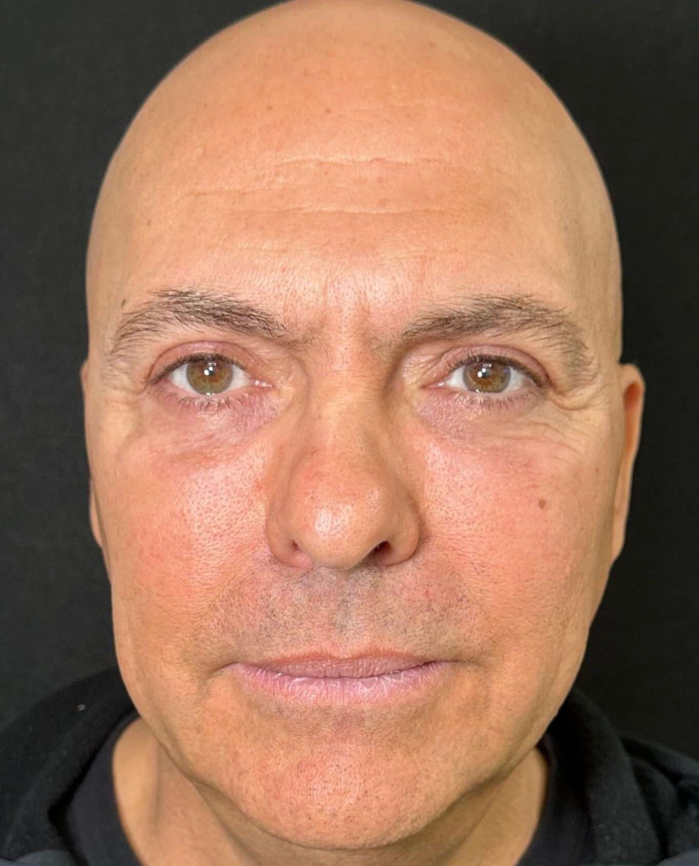 The Plastics Doc (Samuel Salcedo, MD) eyelid lift after — Corona, CA