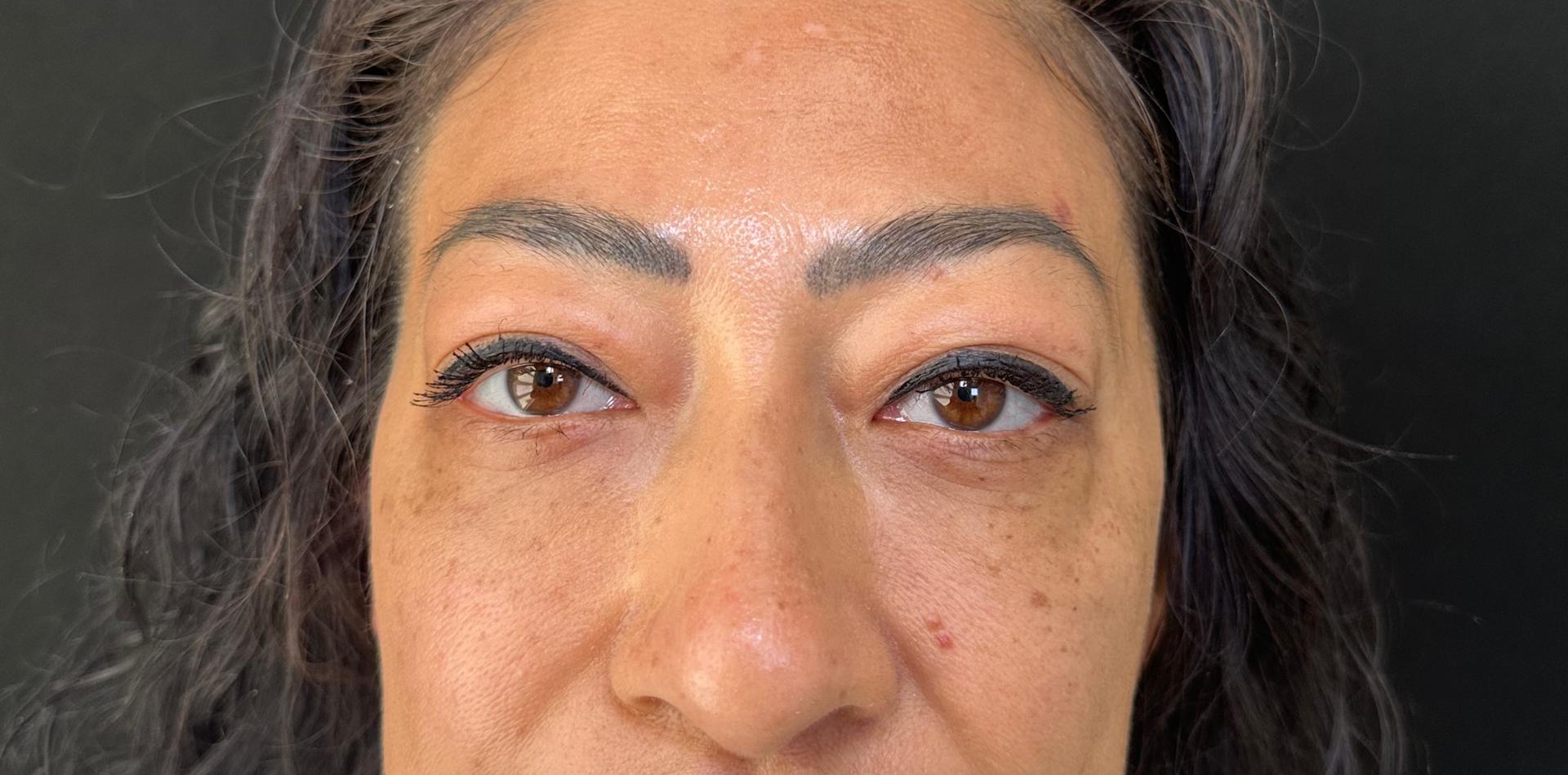 The Plastics Doc (Samuel Salcedo, MD) eyelid lift after — Corona, CA