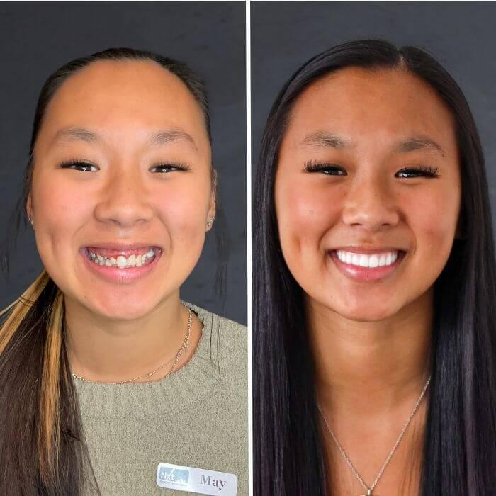 Stubbs Dental Implant Center veneers result — Salt Lake City, UT