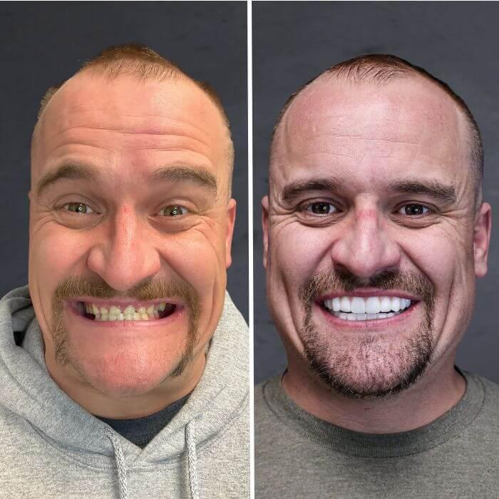 Stubbs Dental Implant Center veneers result — Salt Lake City, UT