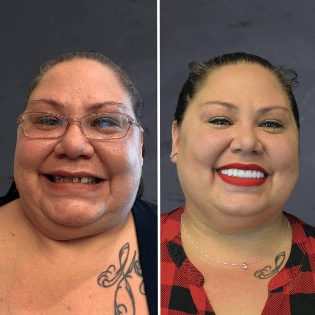 Dental Implants result at Stubbs Dental Implant Center in Murray, UT