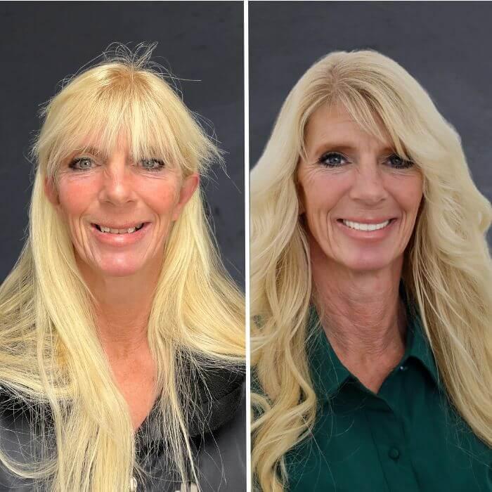 Stubbs Dental Implant Center veneers result — Salt Lake City, UT