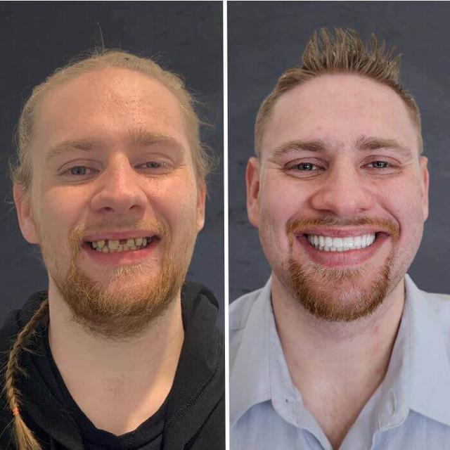 Dental Implants result at Stubbs Dental Implant Center in Murray, UT