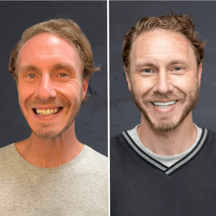 Stubbs Dental Implant Center veneers result — Salt Lake City, UT