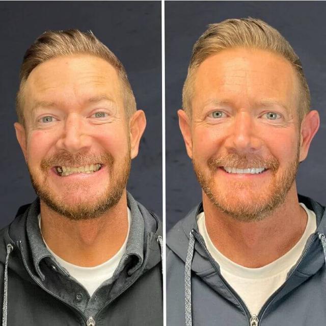 Dental Implants result at Stubbs Dental Implant Center in Murray, UT