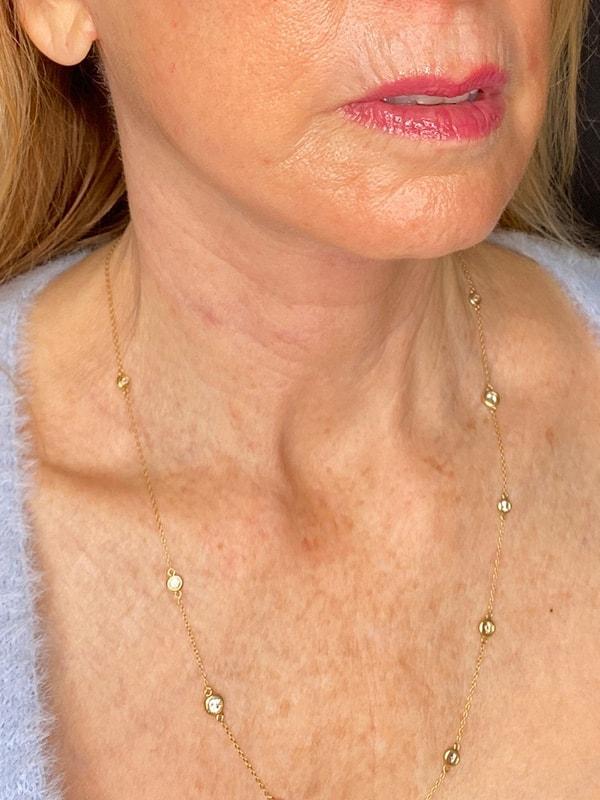 PERK Plastic Surgery (Michelle Lee, MD) neck lift after — Beverly Hills, CA