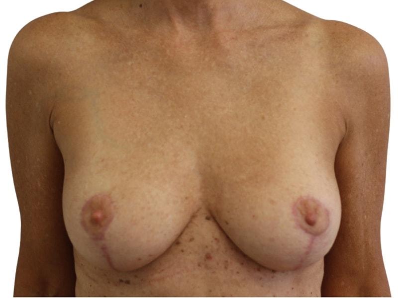 PERK Plastic Surgery (Michelle Lee, MD) breast lift after — Beverly Hills, CA