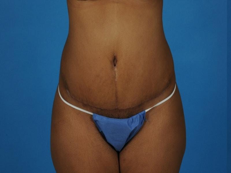 PERK Plastic Surgery (Michelle Lee, MD) tummy tuck after — Beverly Hills, CA