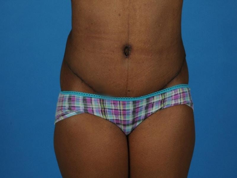 PERK Plastic Surgery (Michelle Lee, MD) tummy tuck after — Beverly Hills, CA