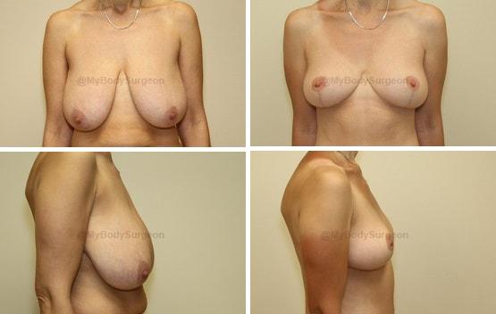 Breast Lift result at Sugar Land Plastic Surgery in Sugar Land, TX