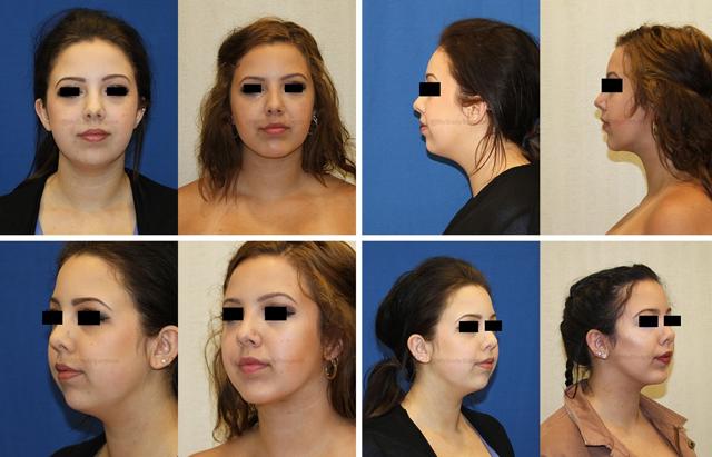Neck Lift result at Sugar Land Plastic Surgery in Sugar Land, TX