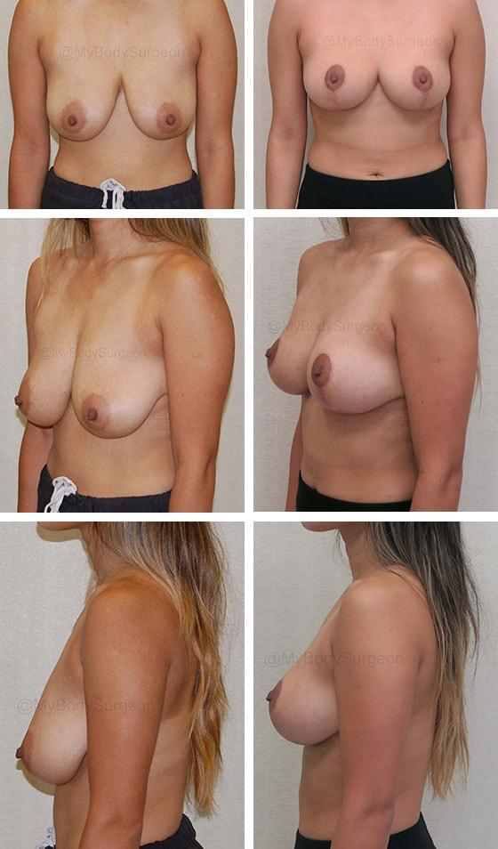 Breast Lift result at Sugar Land Plastic Surgery in Sugar Land, TX