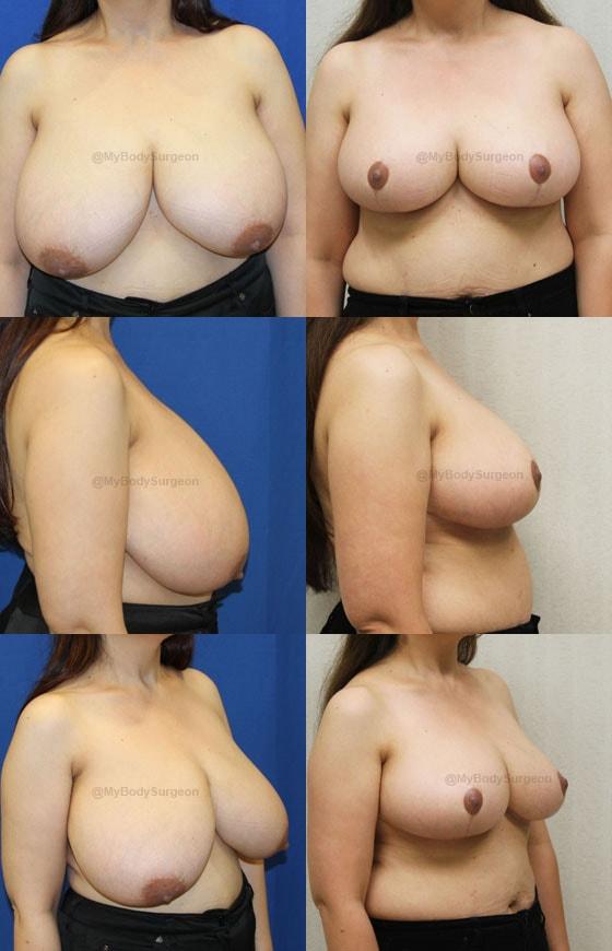 Breast Reduction result at Sugar Land Plastic Surgery in Sugar Land, TX