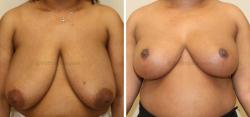 Sugar Land Plastic Surgery breast reduction result — Sugar Land, TX