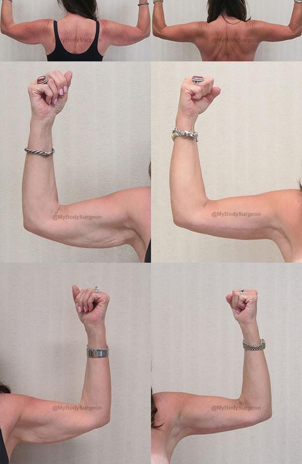 Arm Lift result at Sugar Land Plastic Surgery in Sugar Land, TX