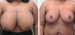 Sugar Land Plastic Surgery breast reduction result — Sugar Land, TX