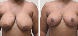 Sugar Land Plastic Surgery breast reduction result — Sugar Land, TX