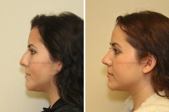 Rhinoplasty result at Sugar Land Plastic Surgery in Sugar Land, TX