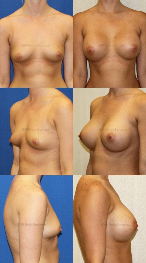 Breast Augmentation result at Sugar Land Plastic Surgery in Sugar Land, TX