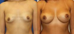 Breast Augmentation result at Sugar Land Plastic Surgery in Sugar Land, TX