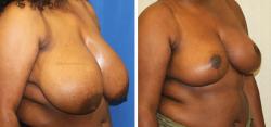 Sugar Land Plastic Surgery breast reduction result — Sugar Land, TX
