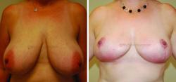 Sugar Land Plastic Surgery breast reduction result — Sugar Land, TX