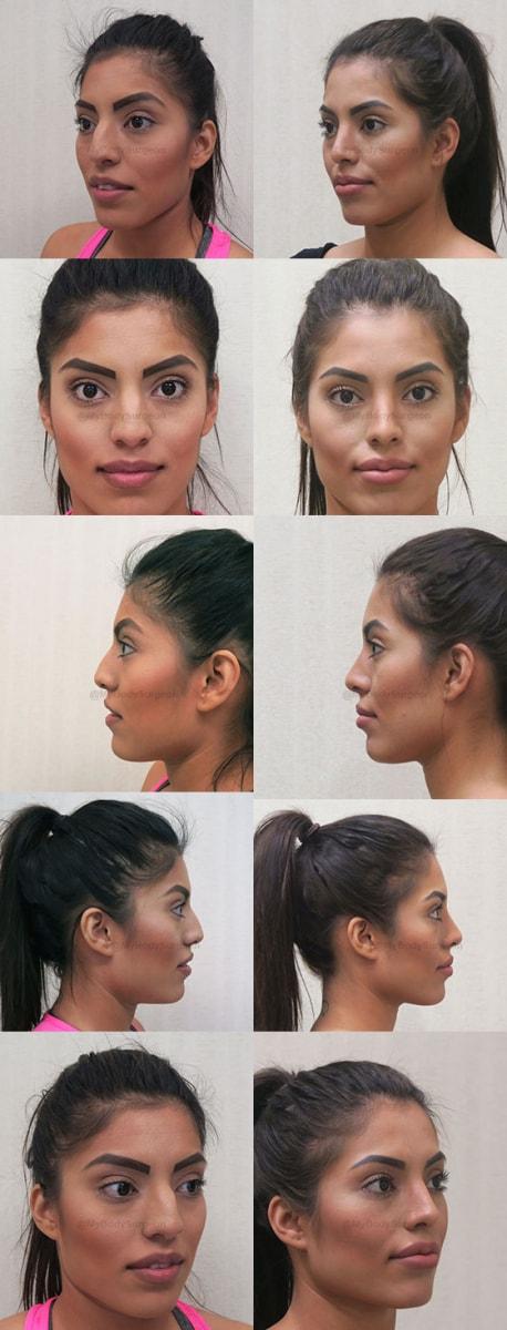 Rhinoplasty result at Sugar Land Plastic Surgery in Sugar Land, TX
