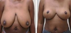 Breast Lift result at Sugar Land Plastic Surgery in Sugar Land, TX