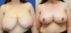 Sugar Land Plastic Surgery breast reduction result — Sugar Land, TX